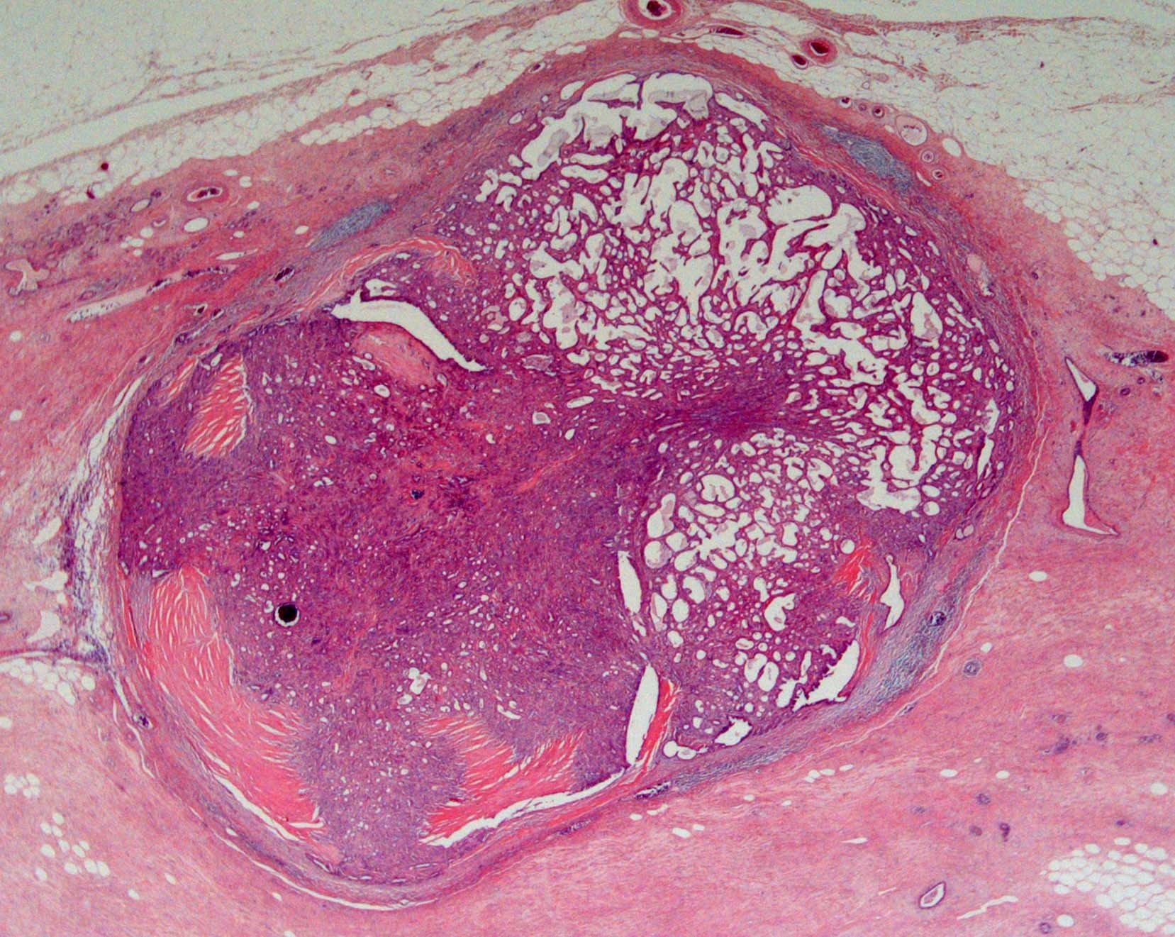 Adenoma papilloma - Jóindulatú emlődaganatok